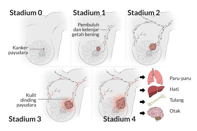 stadium kanker payudara